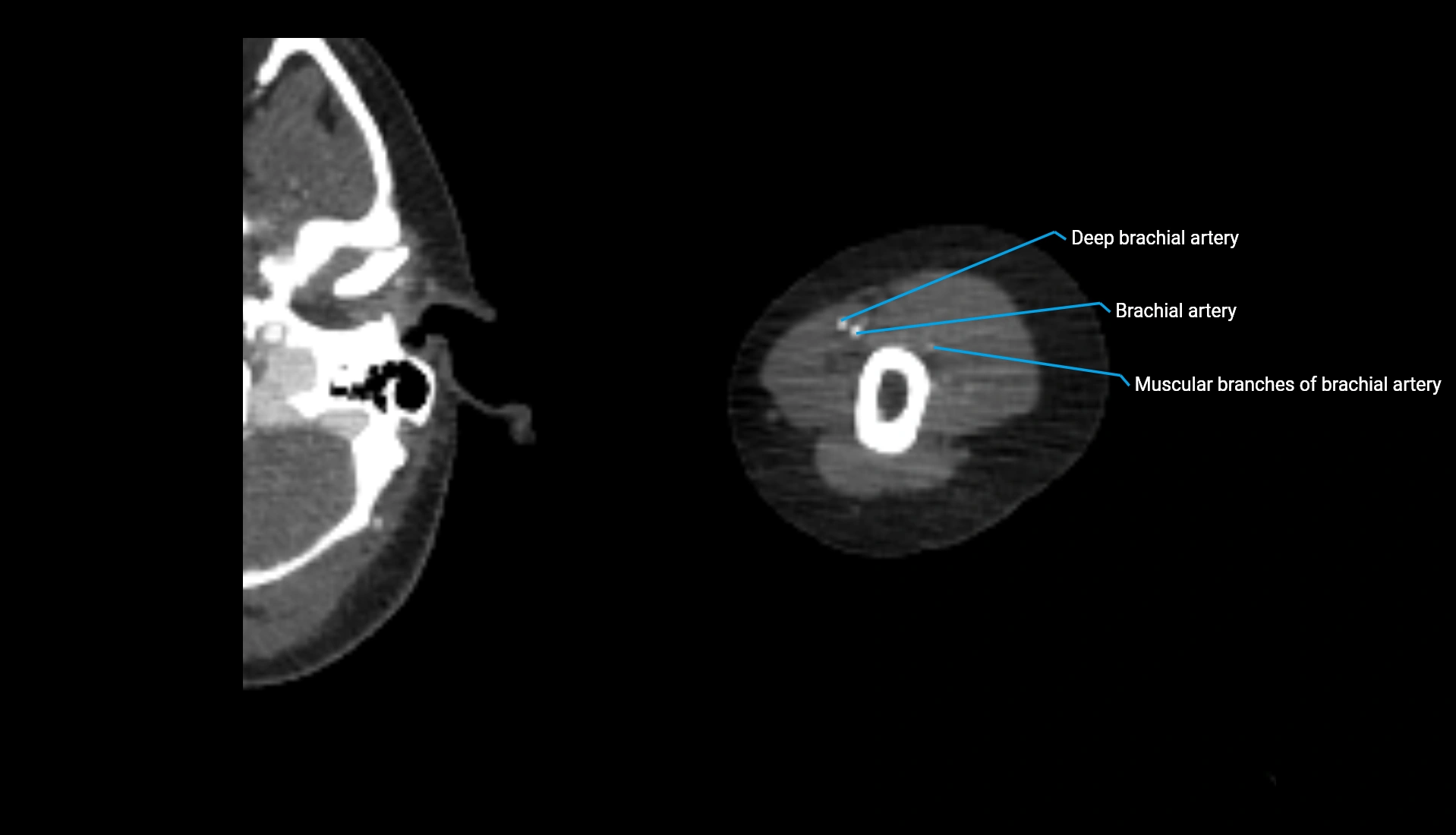 CTA upper limb axial cross sectional anatomy labelled image 267 (2).webp